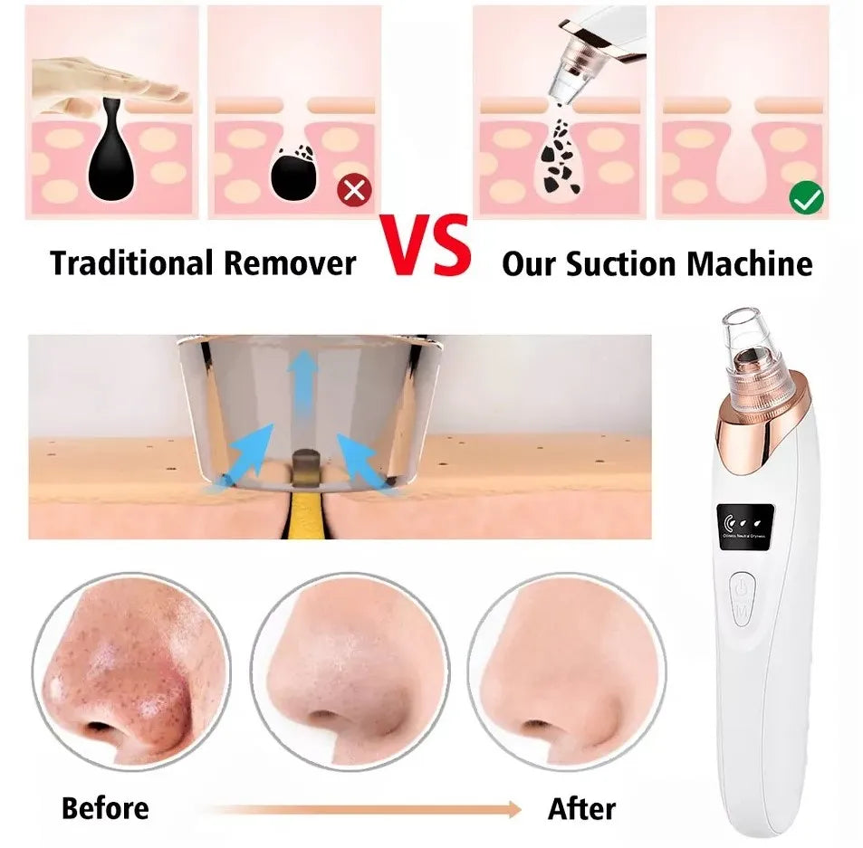 2026 Blackhead Remover with 5 Suction Heads