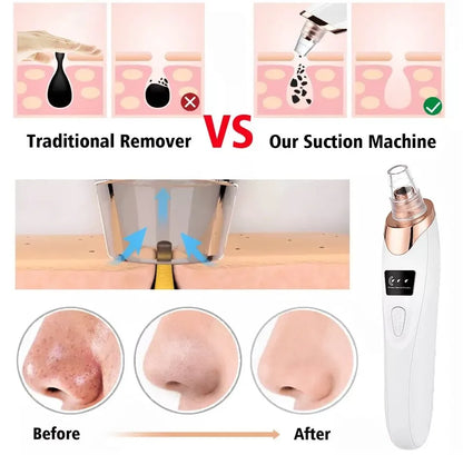 2026 Blackhead Remover with 5 Suction Heads